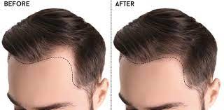 Hair Transplant Doctor